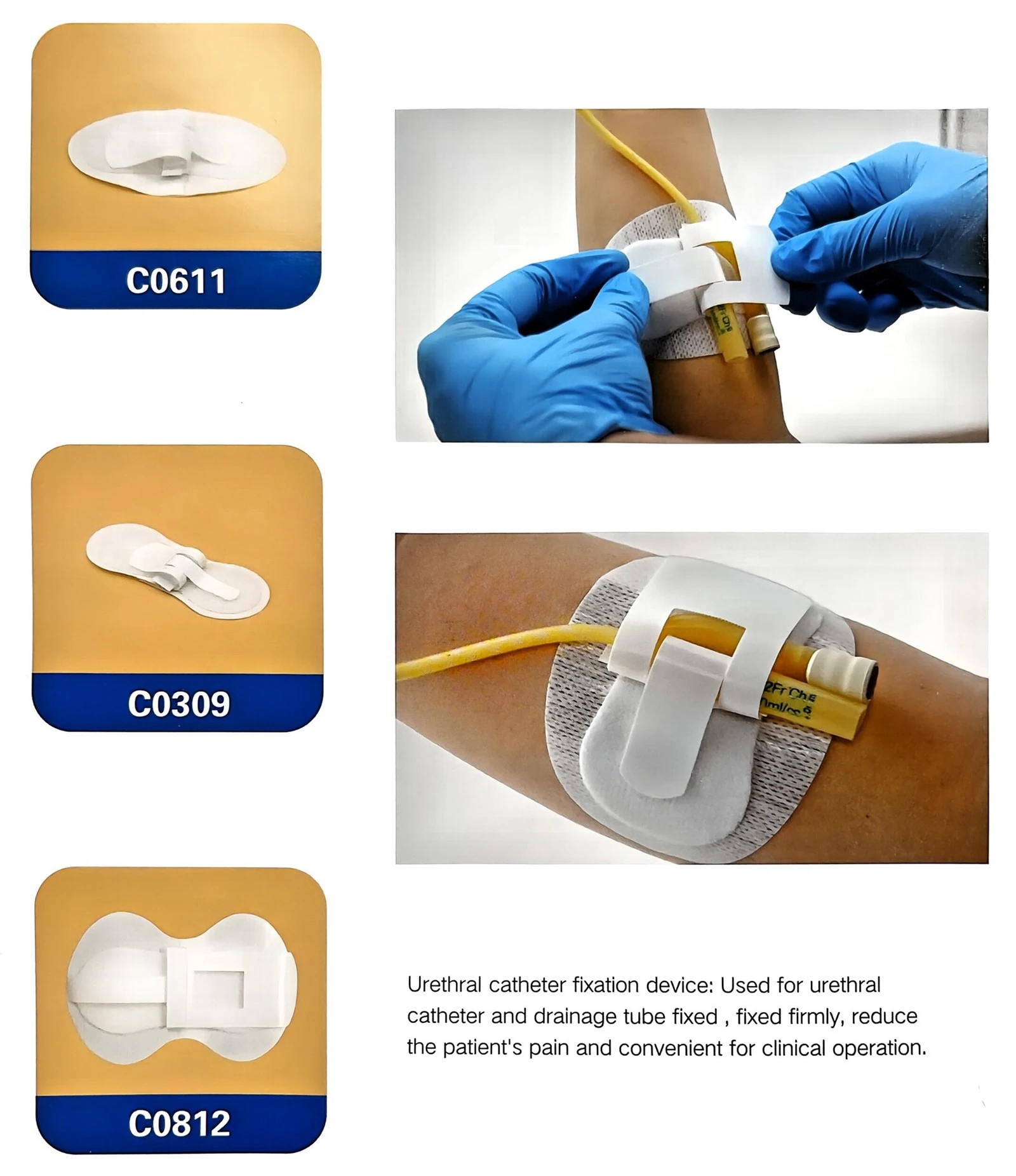Urethral Catheter Fixation Device Urethral Catheter Fixation Device